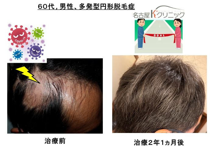 円形脱毛症　病院